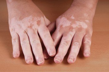 7 Remedios con Plantas para el Vitiligo